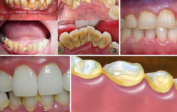 Những nguyên nhân gây ra vôi răng dưới nướu là gì?
