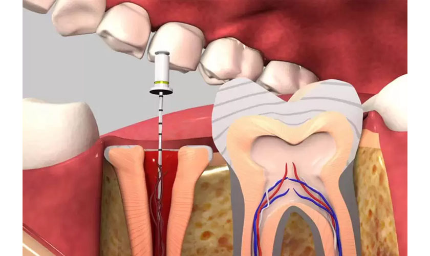 Lấy tủy bọc răng sứ mất khoảng bao lâu?