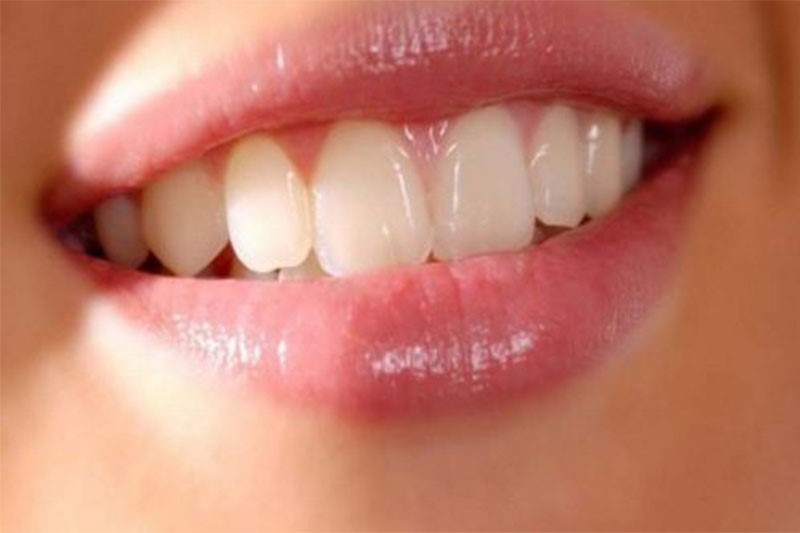 Có những phương pháp nào khác để cải thiện thẩm mỹ và chức năng của răng cửa?