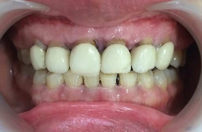 Những nguyên nhân dẫn đến việc răng sứ bị hỏng