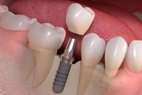 Trồng răng sứ Implant