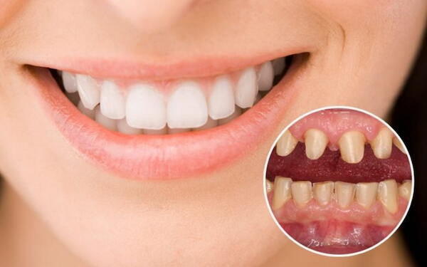 Bọc răng sứ bị đau có nguy hiểm hay không?