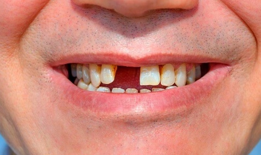 Những ảnh hưởng đến sức khỏe khi nhổ răng cửa vĩnh viễn