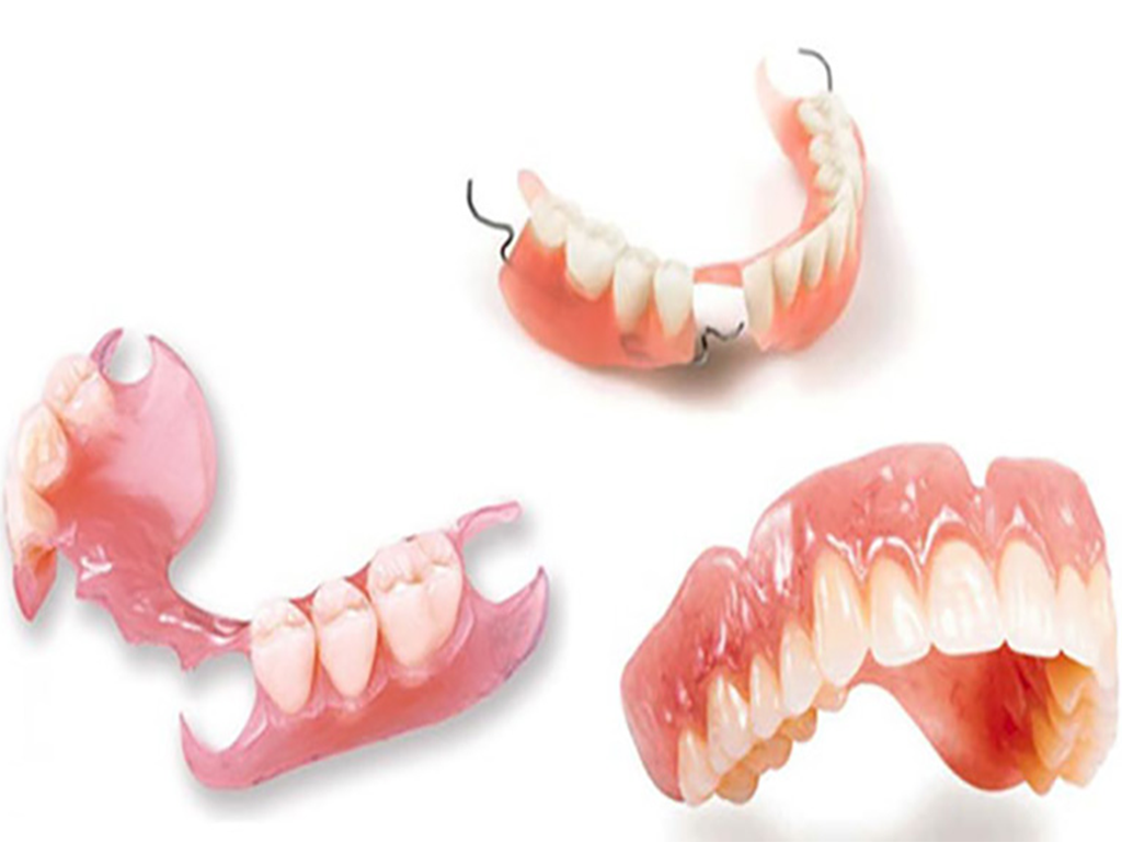 Phương pháp trồng răng giả bằng hàm tháo lắp