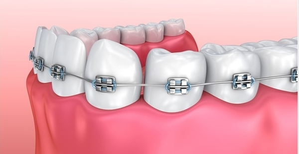 Đừng bỏ qua nha khoa Up Dental nếu bạn muốn niềng răng