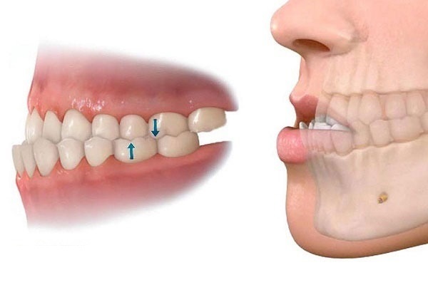 Móm răng có thể là do di truyền từ ông bà hay cha mẹ