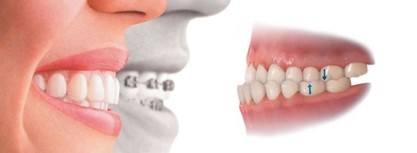 Hiện nay có bao nhiêu phương pháp niềng răng móm phổ biến?