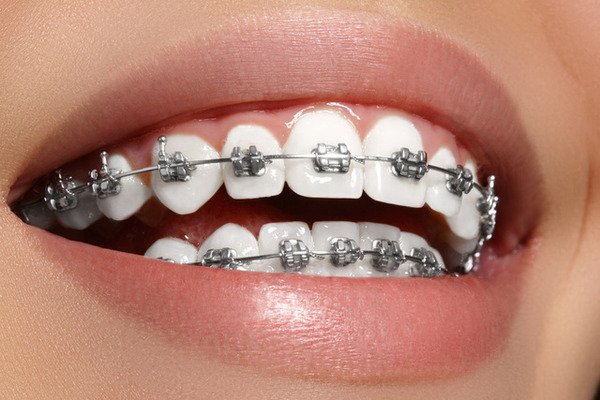 Niềng răng móm bằng các loại mắc cài khác nhau