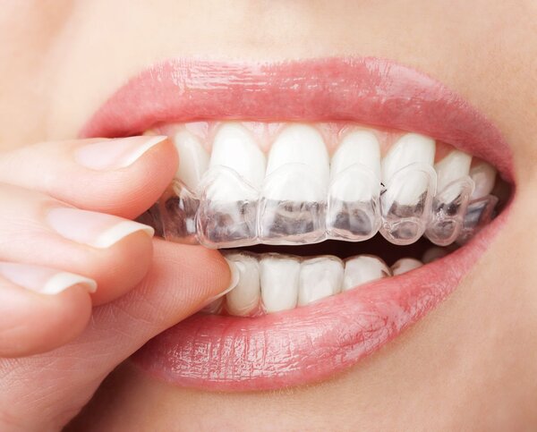Cải thiện tình trạng móm răng bằng niềng trong suốt Invisalign