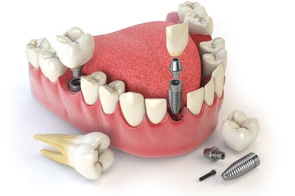Người mang răng implant có cần chăm sóc đặc biệt không?
