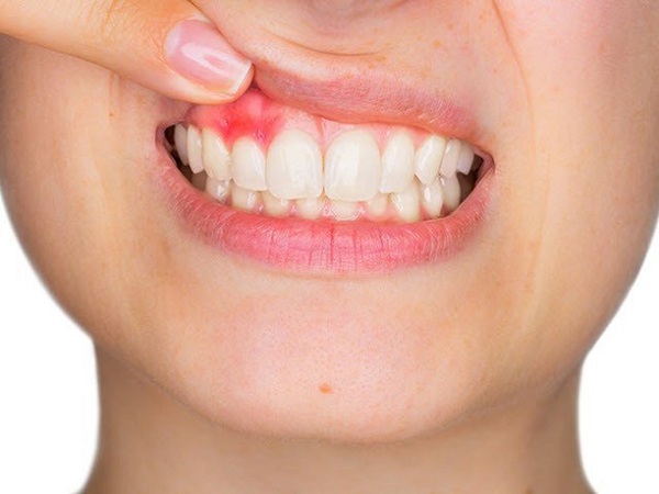 Phương pháp điều trị viêm tủy cho răng bọc sứ là gì?
