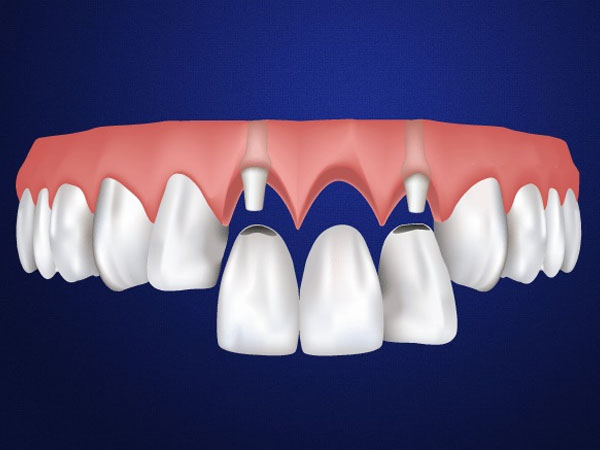 Những dấu hiệu cần lưu ý sau khi trồng lại răng cửa
