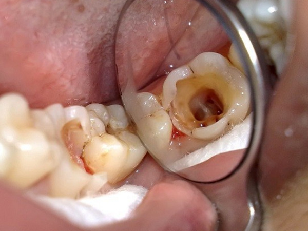 Răng hàm bị sâu nặng bắt buộc phải thay thế bằng răng mới
