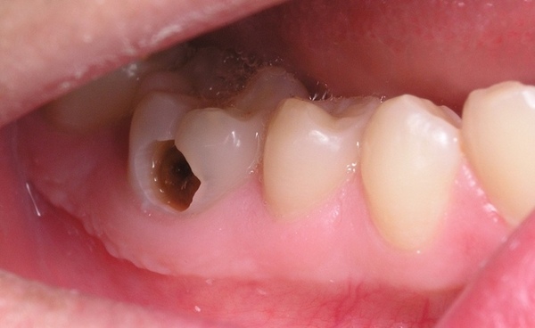 Có rất nhiều trường hợp sâu răng nặng không thể trám được nữa