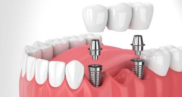 Cắm trụ Implant luôn được xem là giải pháp phục hình răng tốt nhất
