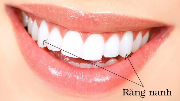 Nếu như mất răng nanh có nên trồng lại hay không?