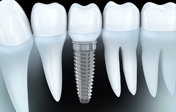 Cắm trụ Implant để thay thế răng nanh đã mất