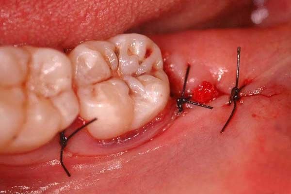 Tại sao không nên để trống răng lâu sau khi nhổ răng?