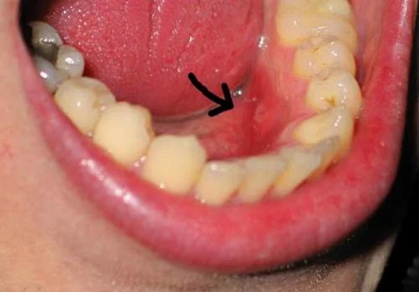 10 Dấu hiệu nhiễm trùng sau khi nhổ răng khôn và cách xử lý hiệu quả