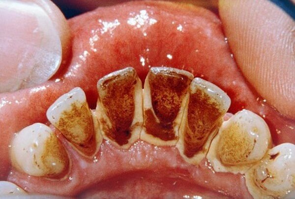 Có cách nào để tái tạo màu tự nhiên cho răng bị đen ở kẽ không?
