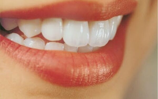 Bọc sứ cho răng cửa là phương pháp vô cùng phổ biến