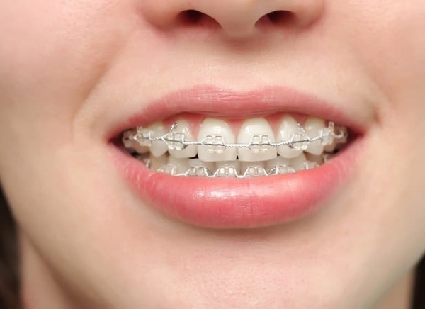 Nhiều người chọn niềng răng để khắc phục tình trạng răng cửa hô và to