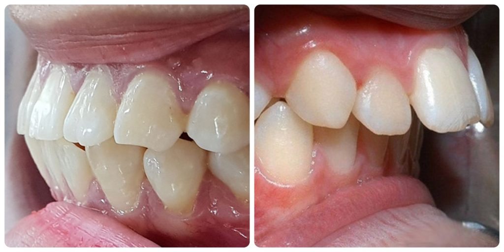Răng hô nặng là gì? Nguyên nhân và cách điều trị răng hô hiệu quả