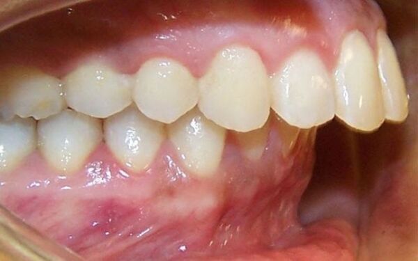 Răng hô nặng là gì? Nguyên nhân và cách điều trị răng hô hiệu quả
