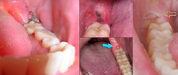 Triệu chứng mọc răng khôn thường gặp