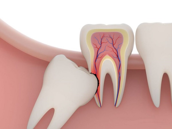 Mọc răng khôn khiến bệnh nhân đau nhức