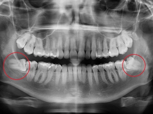 Mọc răng khôn thường chán ăn và cảm giác ăn không ngon miệng