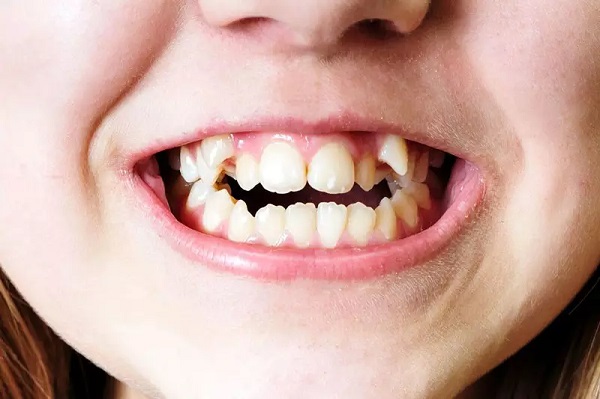 Ai thích hợp để có 2 răng khểnh và liệu việc sửa răng này có phải là phương pháp tốt nhất để cải thiện nụ cười của bạn?