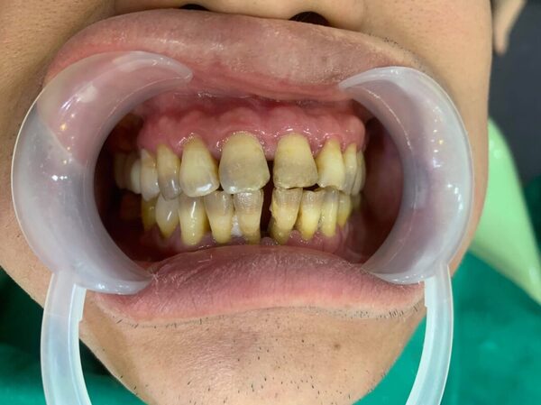 Hàm răng xấu nhất thế giới đã thành thảm họa cho người sở hữu?
