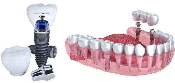 Cấy ghép implant giá rẻ 2