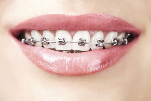 Niềng răng và trồng răng Implant là phương pháp như thế nào?