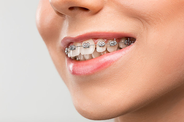 Trồng răng Implant rồi thì có niềng răng được nữa hay không?