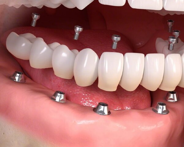 Implant là phương pháp như thế nào và tại sao nên thực hiện nó?