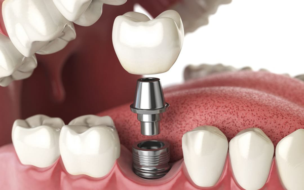 TOP 11 địa chỉ trồng răng implant uy tín giá rẻ tại TP.HCM 2