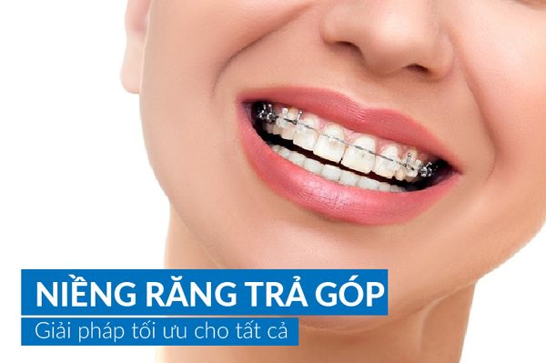 Top 11 địa chỉ niềng răng trả góp tại Tp. HCM 2