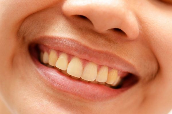 Răng bị ố vàng do bám bẩn ngoài răng