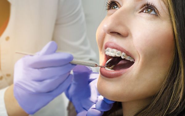Niềng răng có được uống thuốc giảm đau hay không?