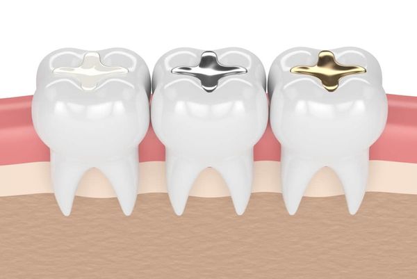 Tìm hiểu về trám răng thủ đức và những lợi ích của việc trám răng