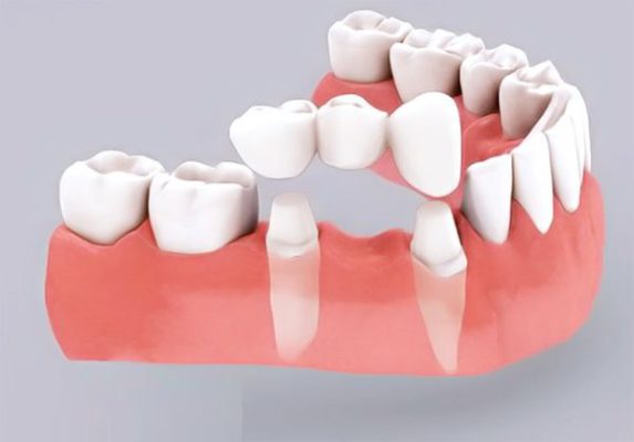 Bảng báo giá thay răng cả hàm tại thủ đức tp hcm 3