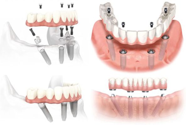 Bảng báo giá thay răng cả hàm tại thủ đức tp hcm 4