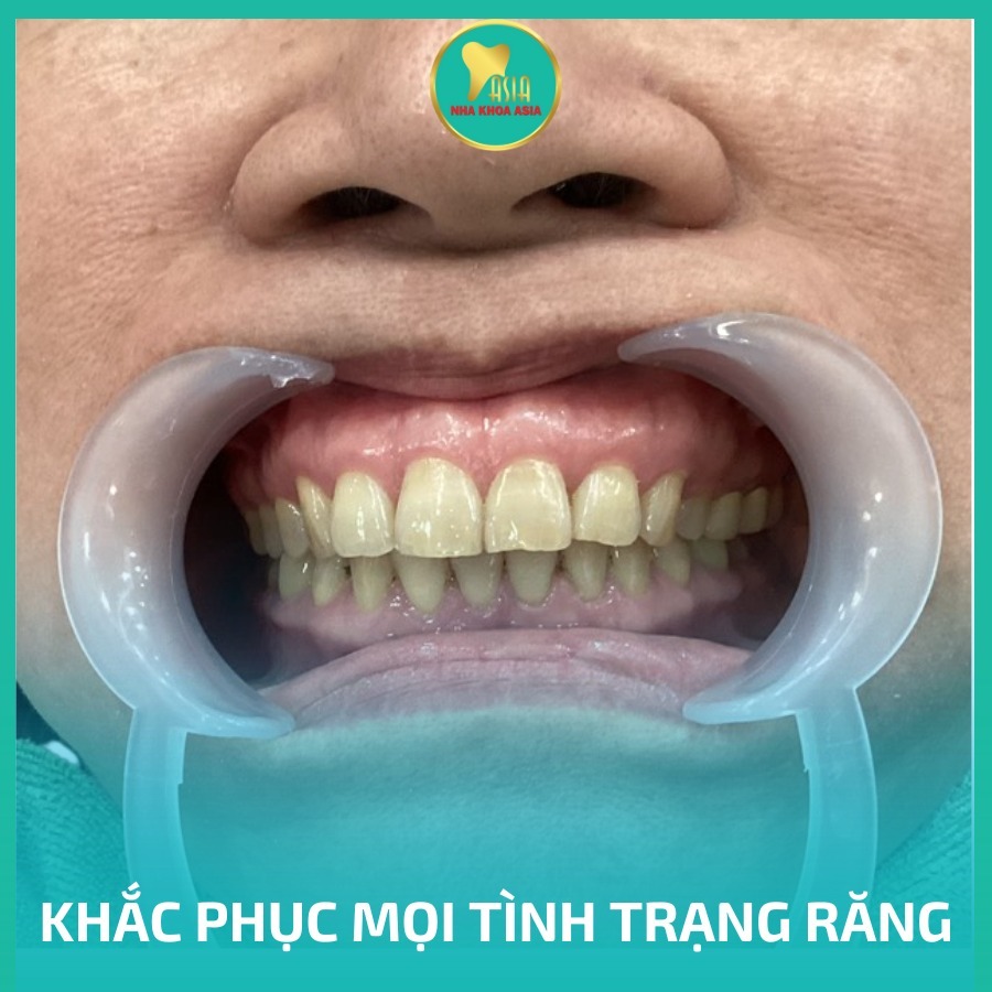 trong-rang-implant