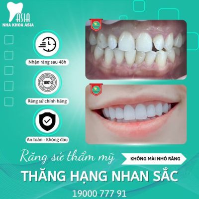 khách hàng bọc sứ tại nha khoa Asia