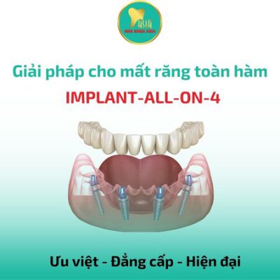 Trồng răng Implant tại Nha Khoa Asia