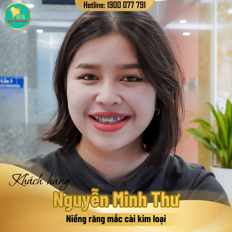 niềng răng tại nha khoa Asia