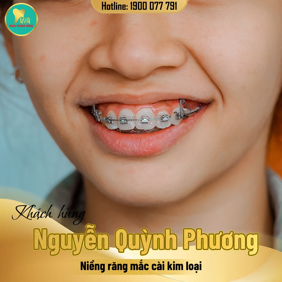 niềng răng tại nha khoa Asia