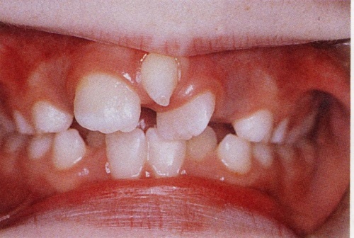 Nguy cơ và vấn đề liên quan đến răng mọc trên lợi